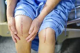 Patient checking knee after successfully knee replacement surgery